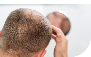 თმის ცვენა